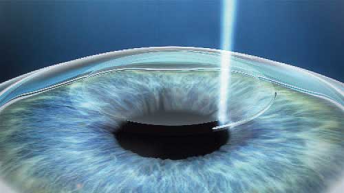 ReLEx SMILE, Augenlasern, OP-Ablauf SMILE