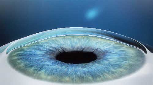 ReLEx SMILE, Augenlasern, OP-Ablauf SMILE